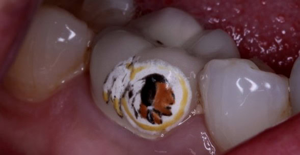 redskins teeth tattoo