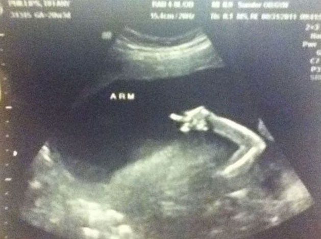 middle-finger-sonogram