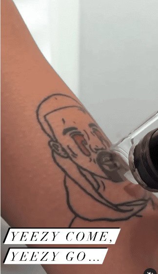 kanye west tattoo removal